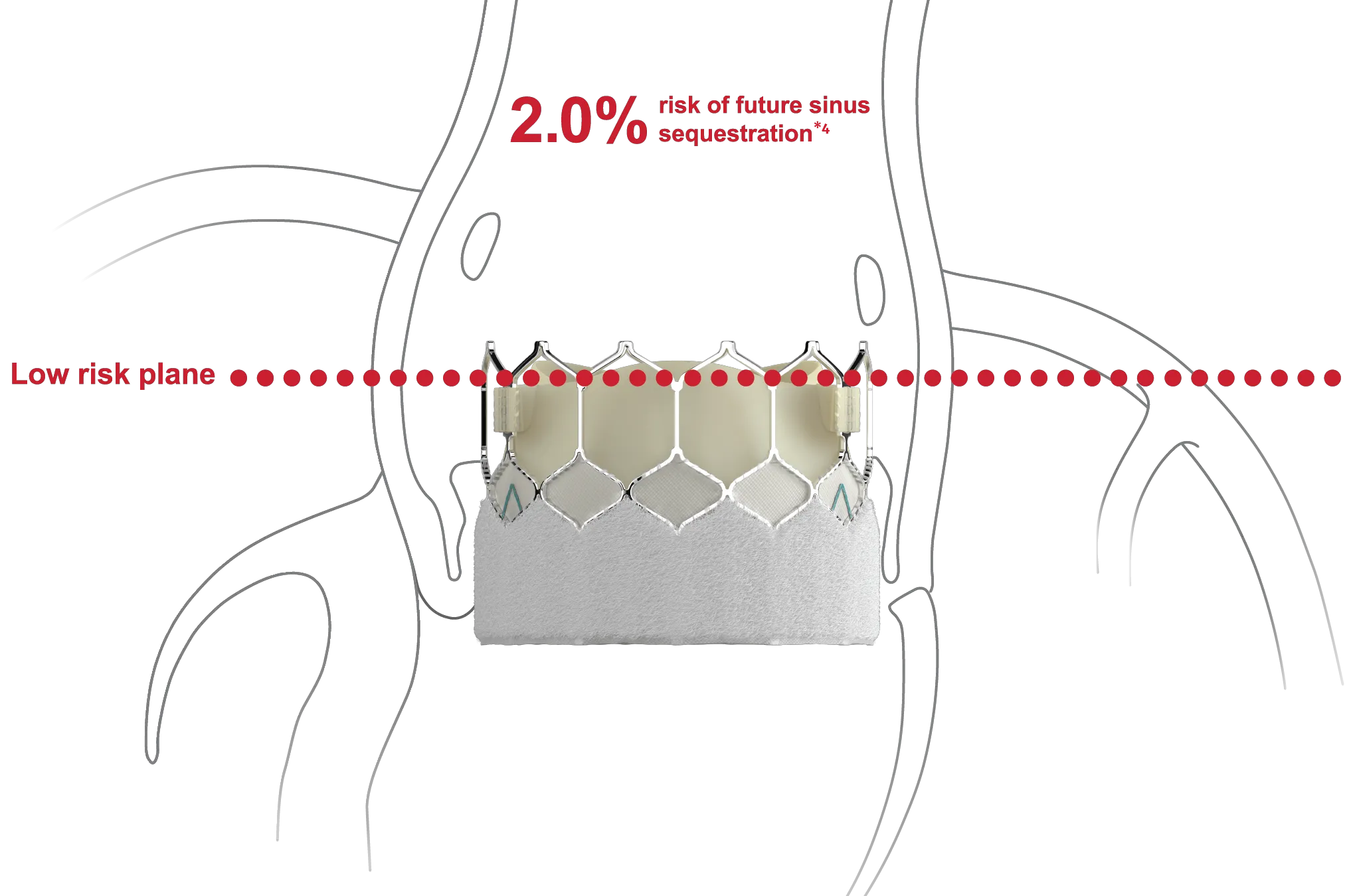 Image of graphic showing design to host future valve reinterventions